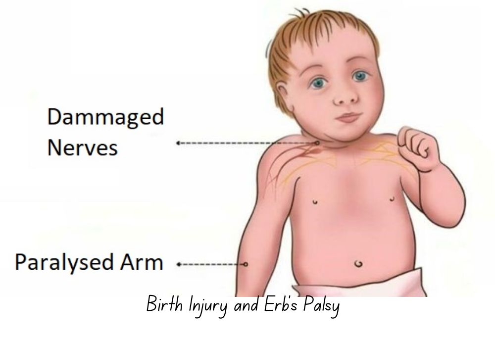 Birth Injury and Erb’s Palsy - Featured Image