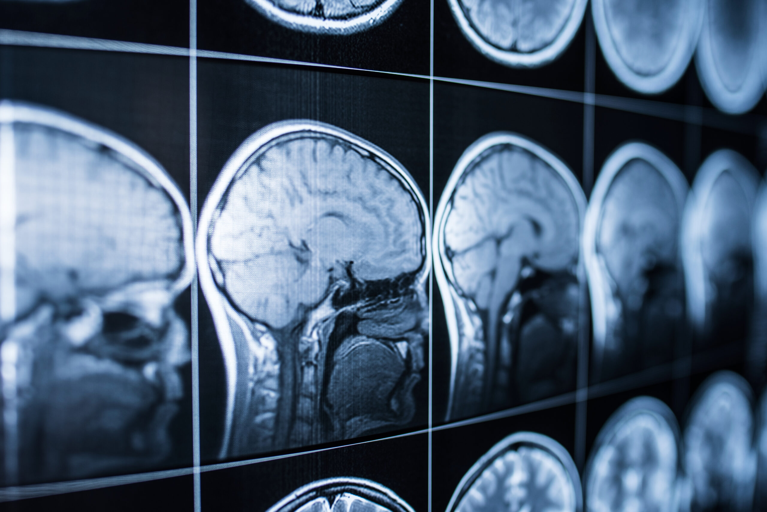 Hoosier Veterans With Traumatic Brain Injuries Or PTSD May Find Relief With Oxygen Therapy