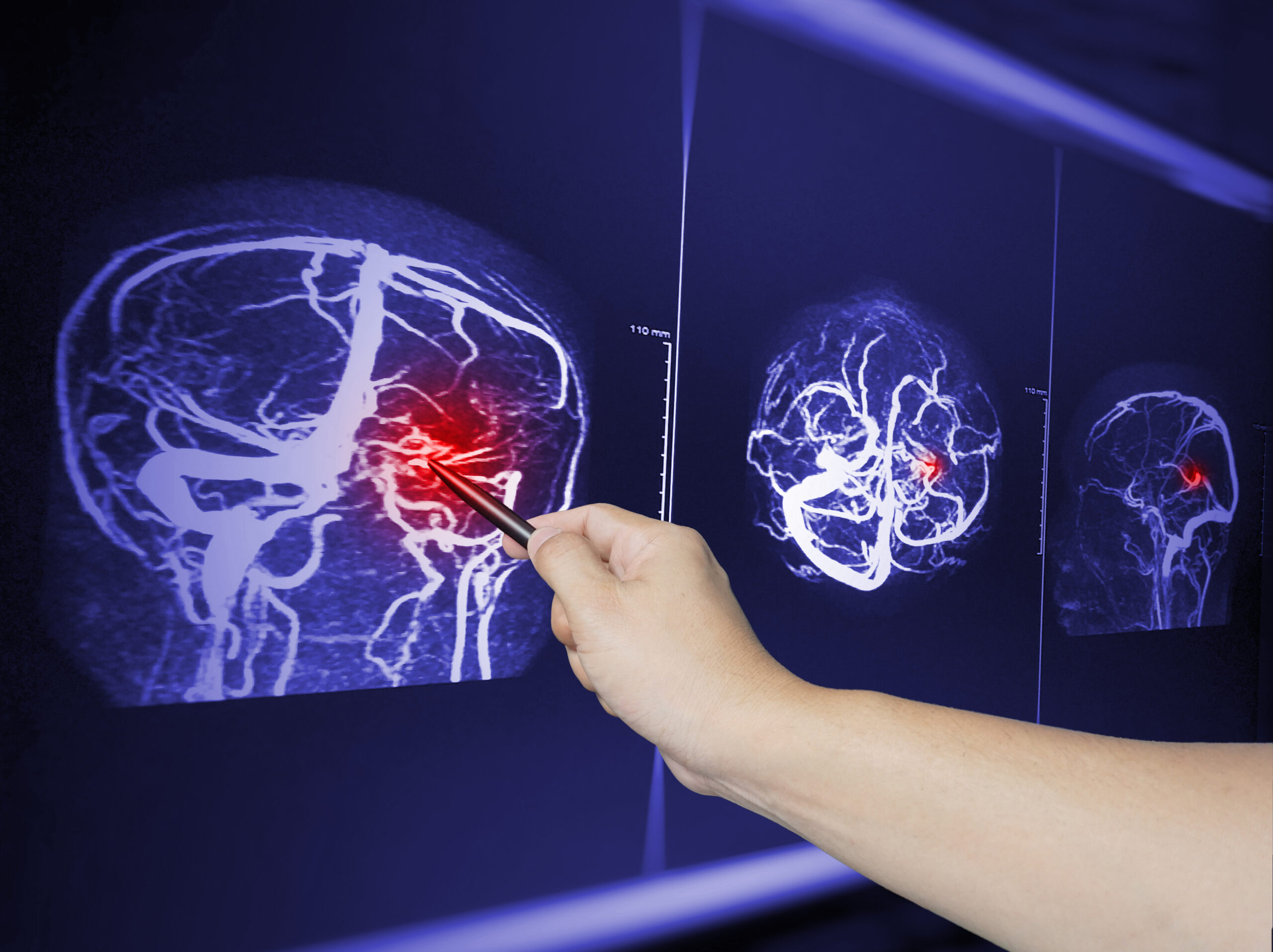 What is Hematoma? 