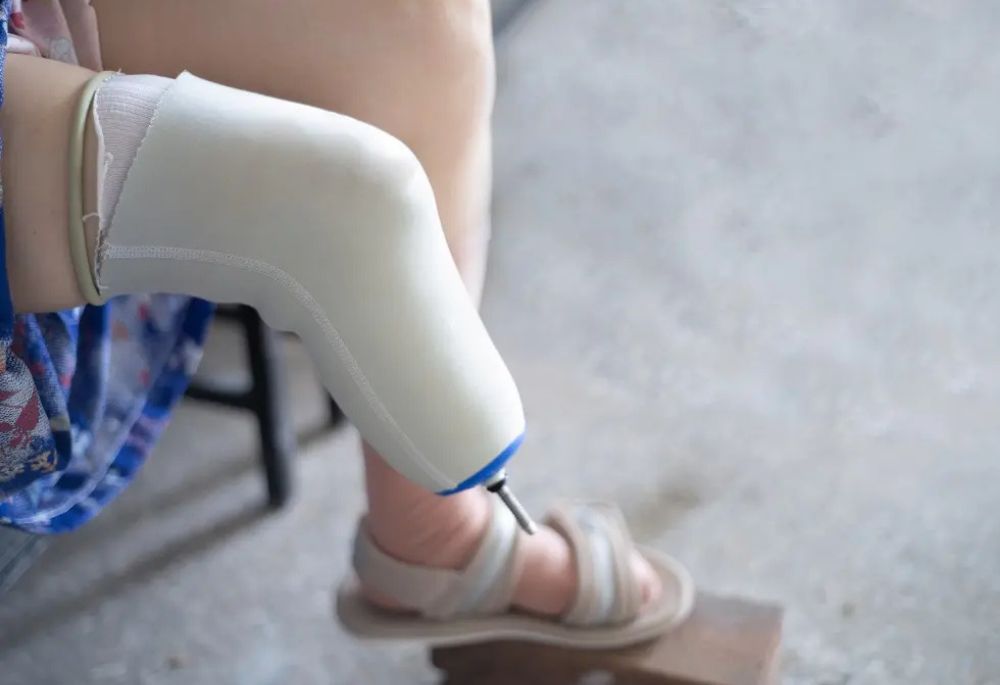 What You Need to Know About Getting Compensation After Limb Loss - Featured Image