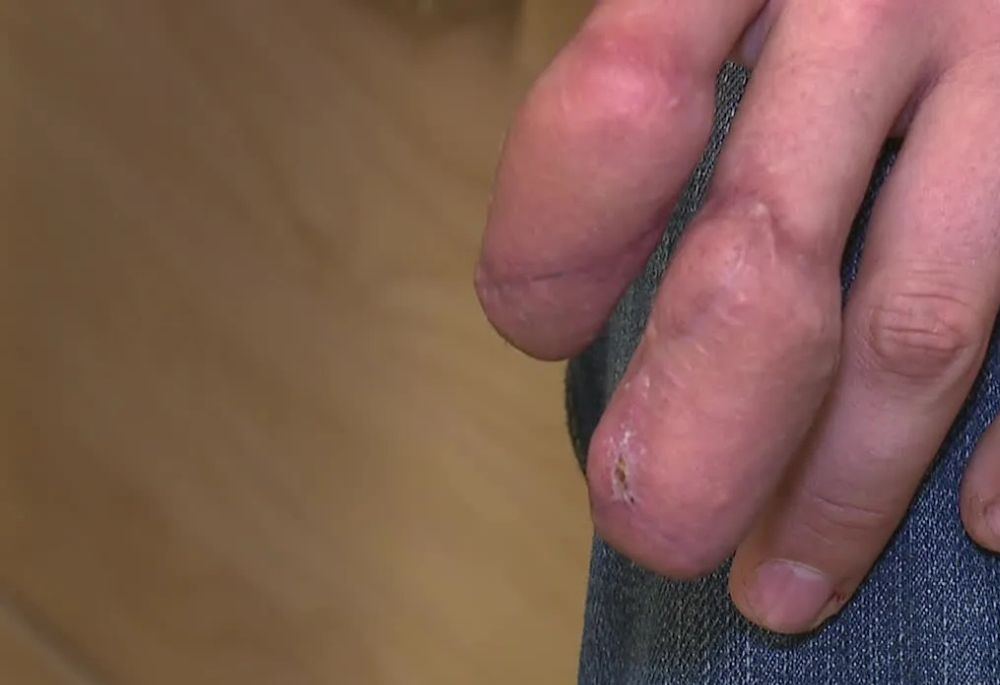 5 Serious Injuries from Fireworks - Featured Image