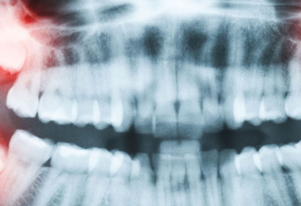 Negligent Wisdom Tooth Extractions Can Result in Lingual Nerve Damage - Featured Image