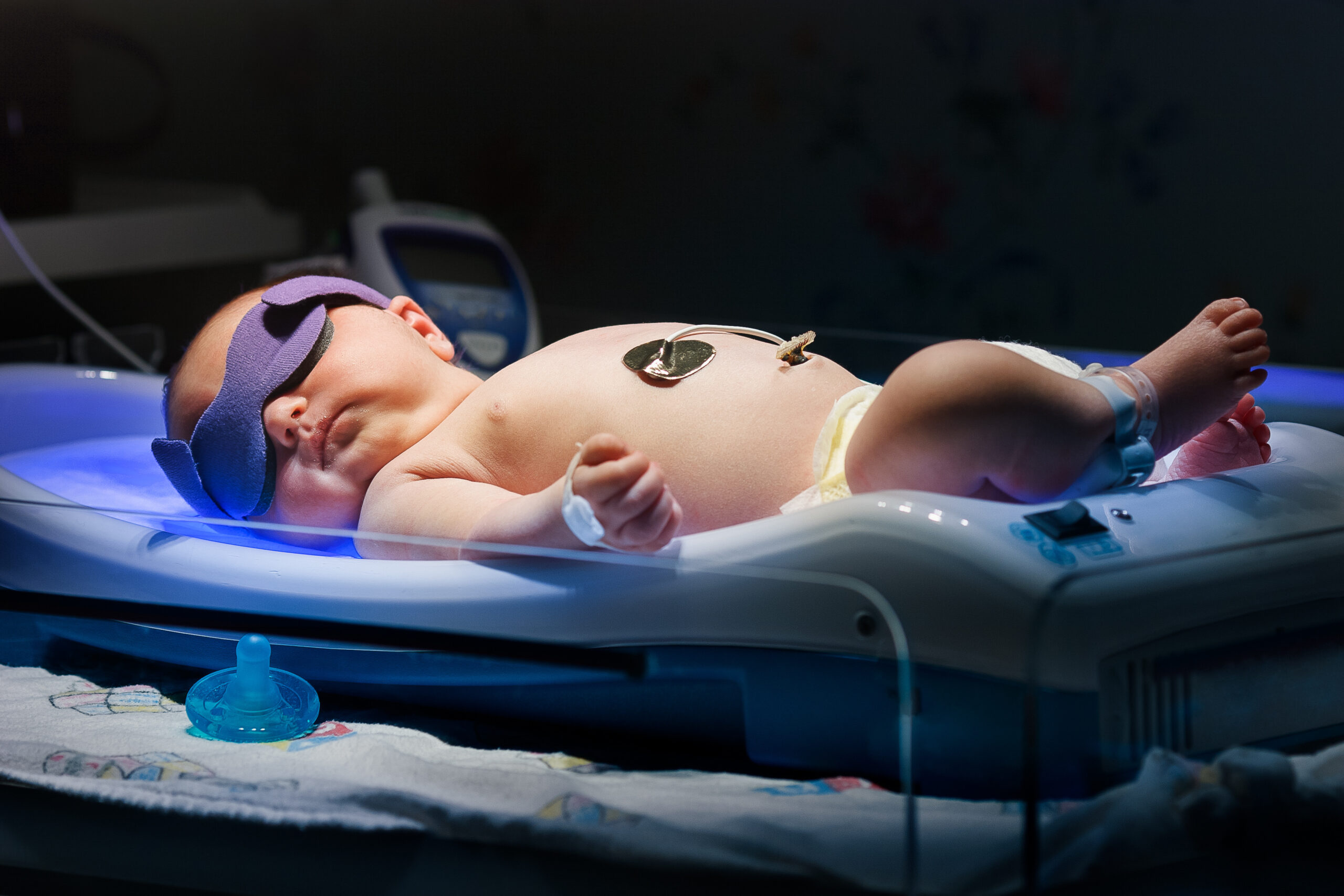 newborn baby with jaundice getting ulta violet phototherepy treatment