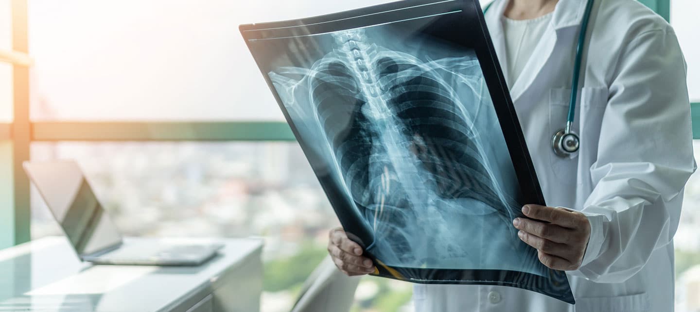 Cauda Equina Syndrome Lawyer